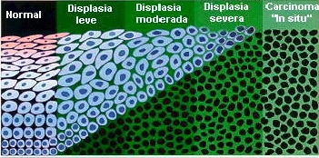 Classificaes dos carcinomas intracervicais (NICs)