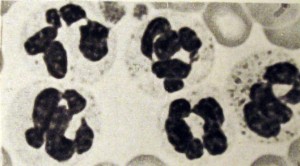 Neutr&oacute;filos com n&uacute;cleo hipersegmentado