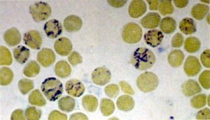 Esfrega&ccedil;o com colora&ccedil;&atilde;o supravital mostrando diversos reticul&oacute;citos