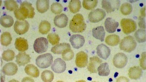 Policromasia de eritr&oacute;citos (nota-se tamb&eacute;m trombocitose)