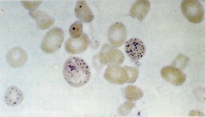 Eritr&oacute;cito com pontilhado basof&iacute;lico