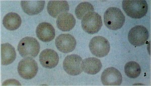 Corpos de Jolly em eritr&oacute;citos (colora&ccedil;&atilde;o de Wright&rsquo;s)