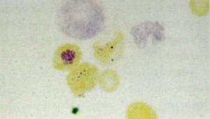 Siderócito Siderócito