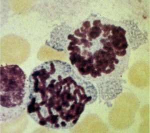 Uma met&aacute;fase tardia e uma jovem em duas c&eacute;lulas carcin&oacute;ides