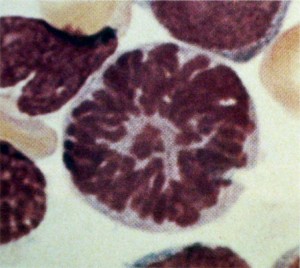 Est&aacute;gio II: met&aacute;fase tardia (mieloblasto)